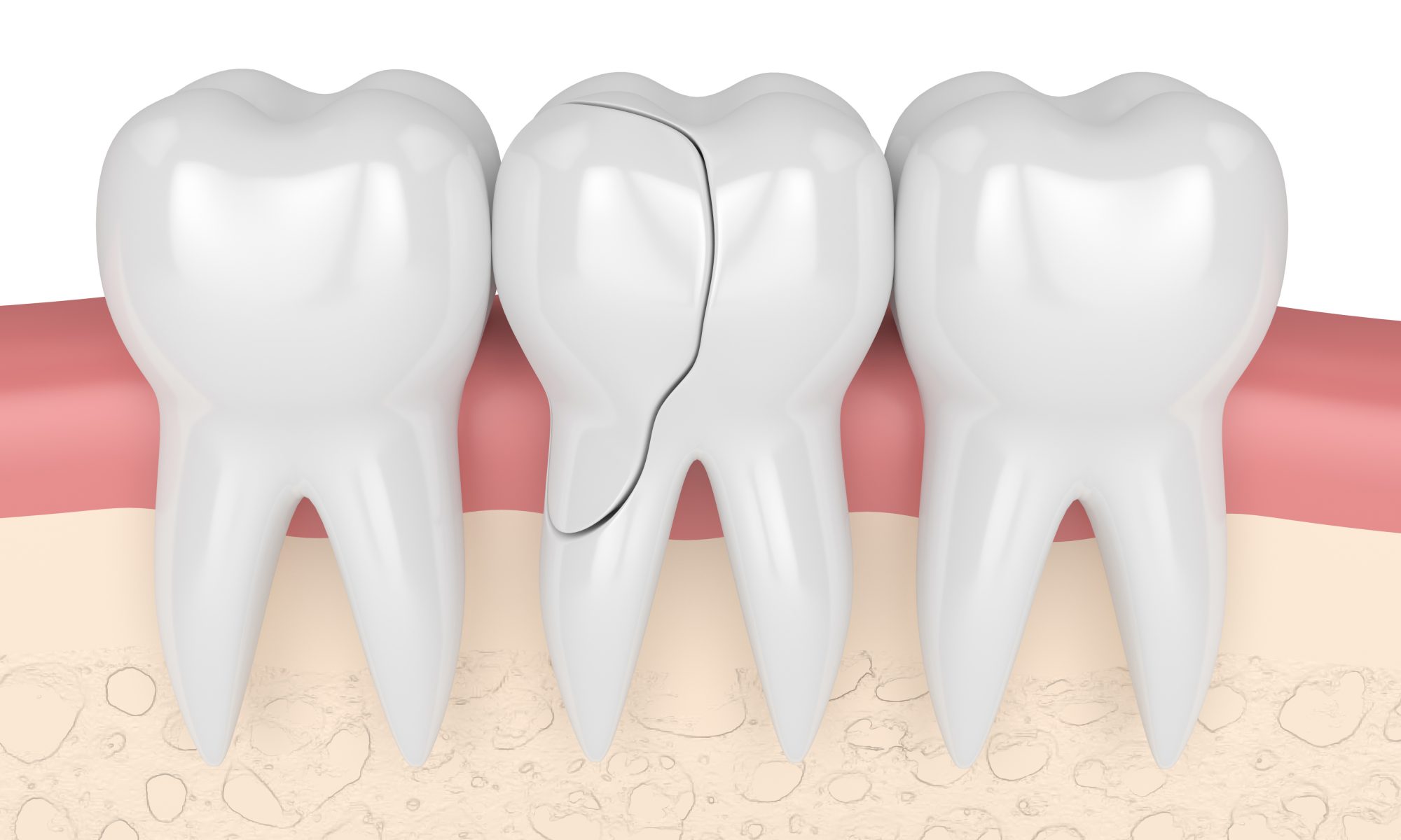 Tooth treatment