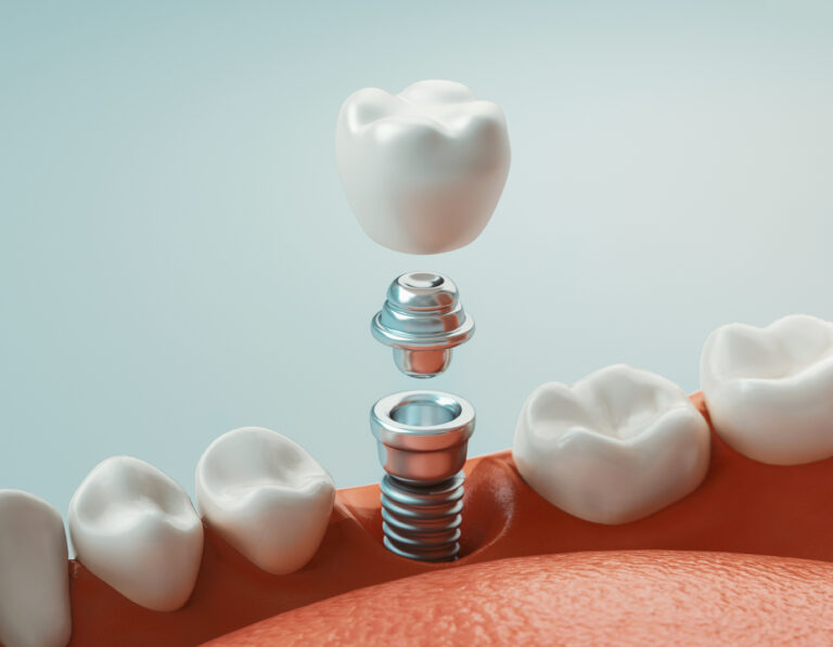 dental implant in San Diego