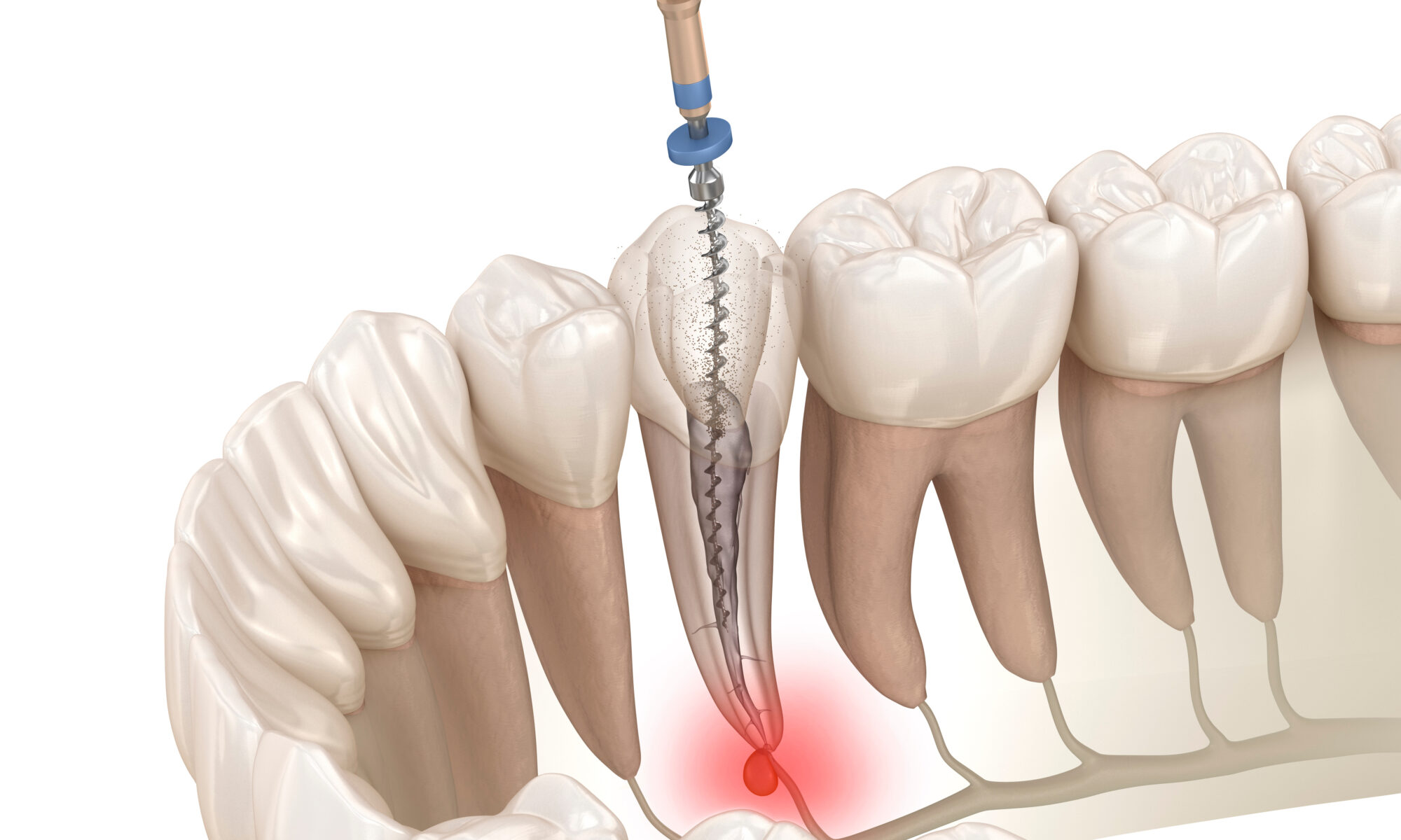Signs That Indicate When Endodontic Treatment is Necessary
