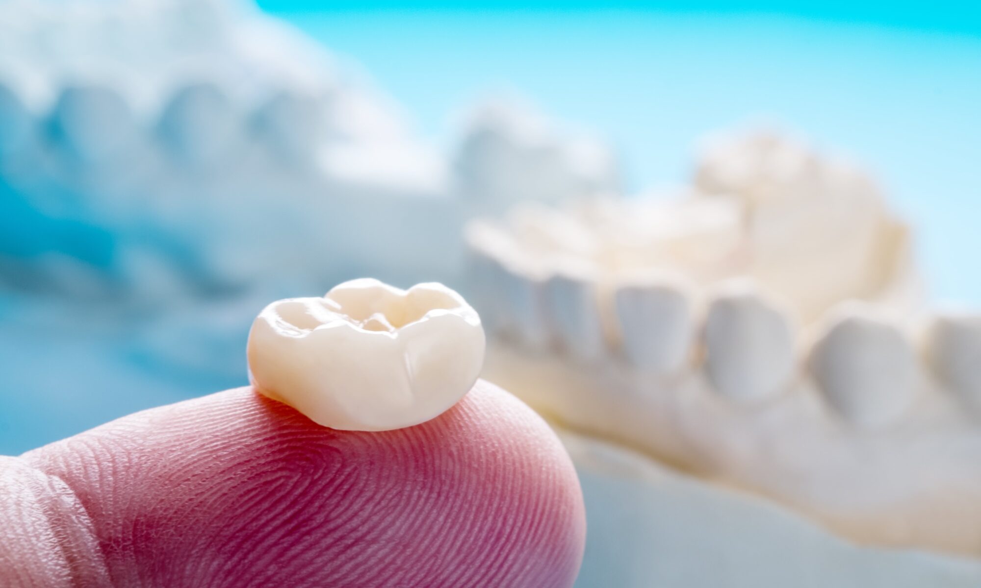 What Are Dental Crowns and Bridges?