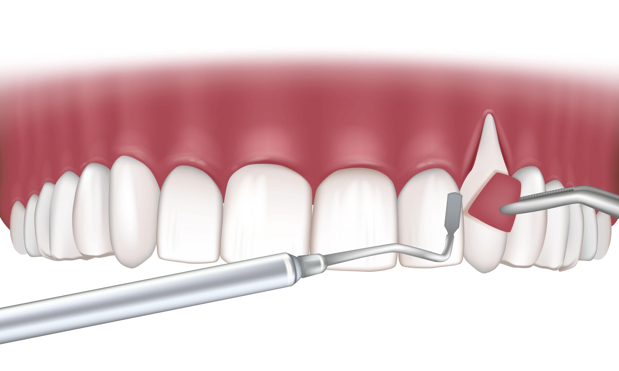 Latest Advancements in Periodontal Surgery Techniques and Technology