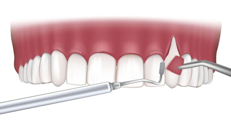 Latest Advancements in Periodontal Surgery Techniques and Technology